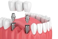 implant-sonrasi-dikkat-edilmesi-gerekenler-6553847fdfa09.jpg